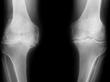 Advanced Osteoarthritis Of The Knee Is Now Being Treated With Regenerative Medicine At The Center For Regenerative Medicine