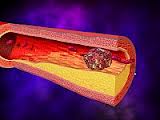 NuvaRing: severe adverse events threat