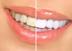 ultra white teeth whitening