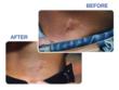Scar before and after Pro-Sil Treatment