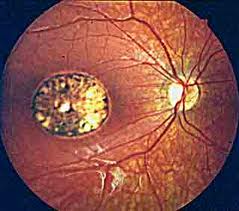 Fosamax: severe adverse events threat