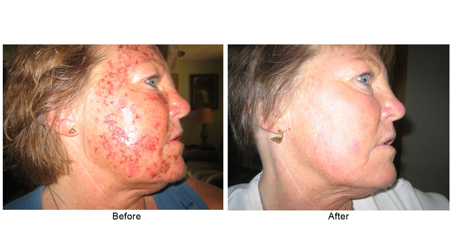 burn victims face before and after