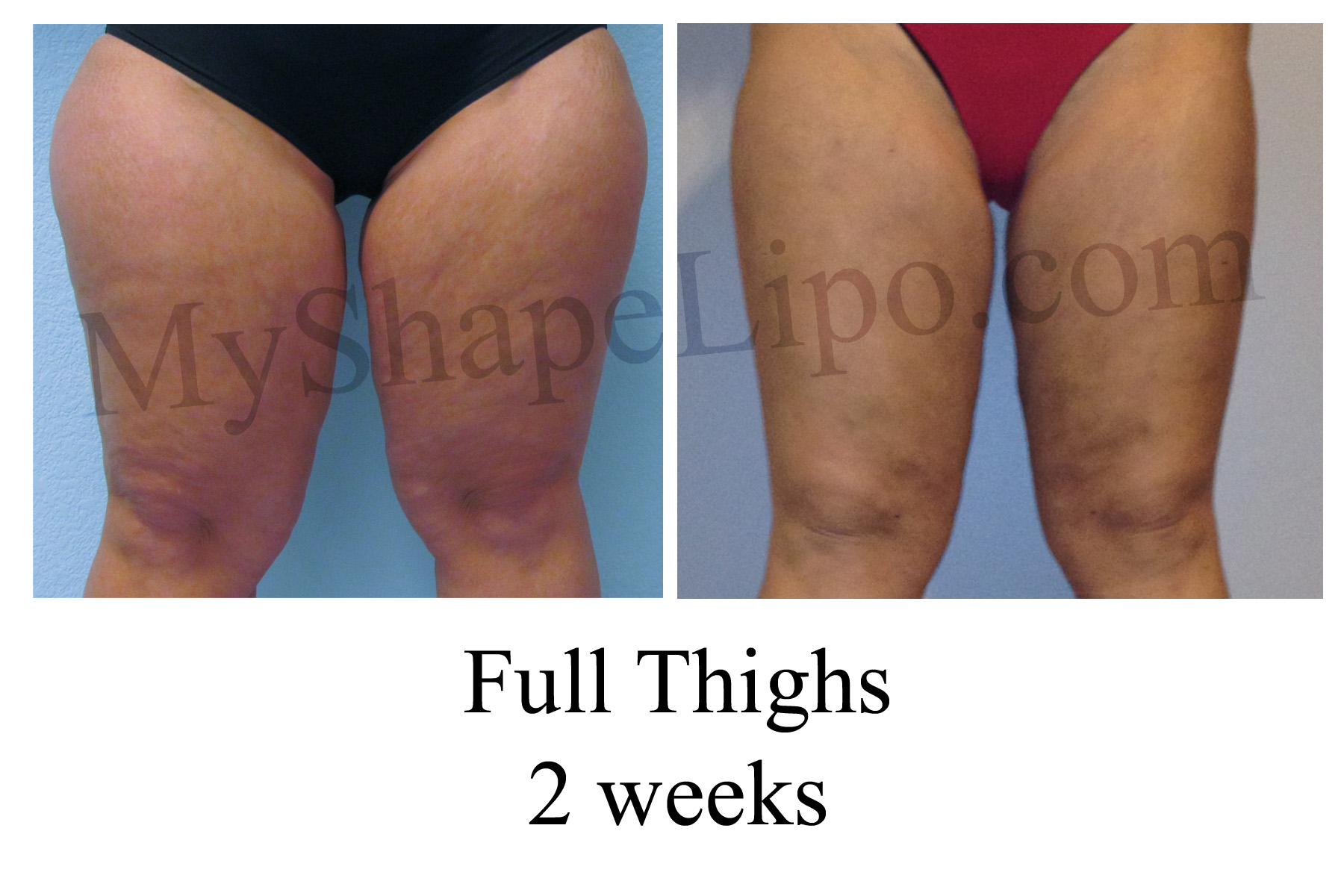 liposuction recovery