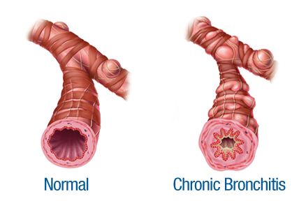 copd and smoking