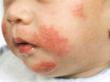 Eczema Treatments for Men, Women and Infants Published by Medical...