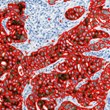 Visiopharm and Omnyx Partner to Advance Cancer Diagnostics with...