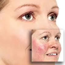 Eczema, Dermatitis, Treatment
