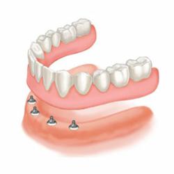 average cost of snap in dentures