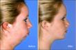 Novel Cosmetic Combination of AccuSculpt Laser Lipolysis, Botox and...