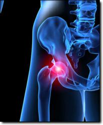 Stryker Hip Recall