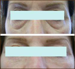 Before and After Tear Trough Images