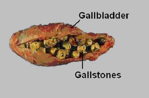 gallbladder disease symptoms