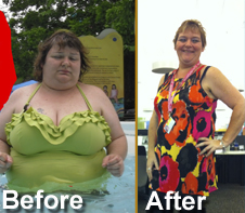 gastric bypass success story