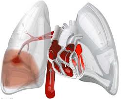 NuvaRing: severe adverse events threat