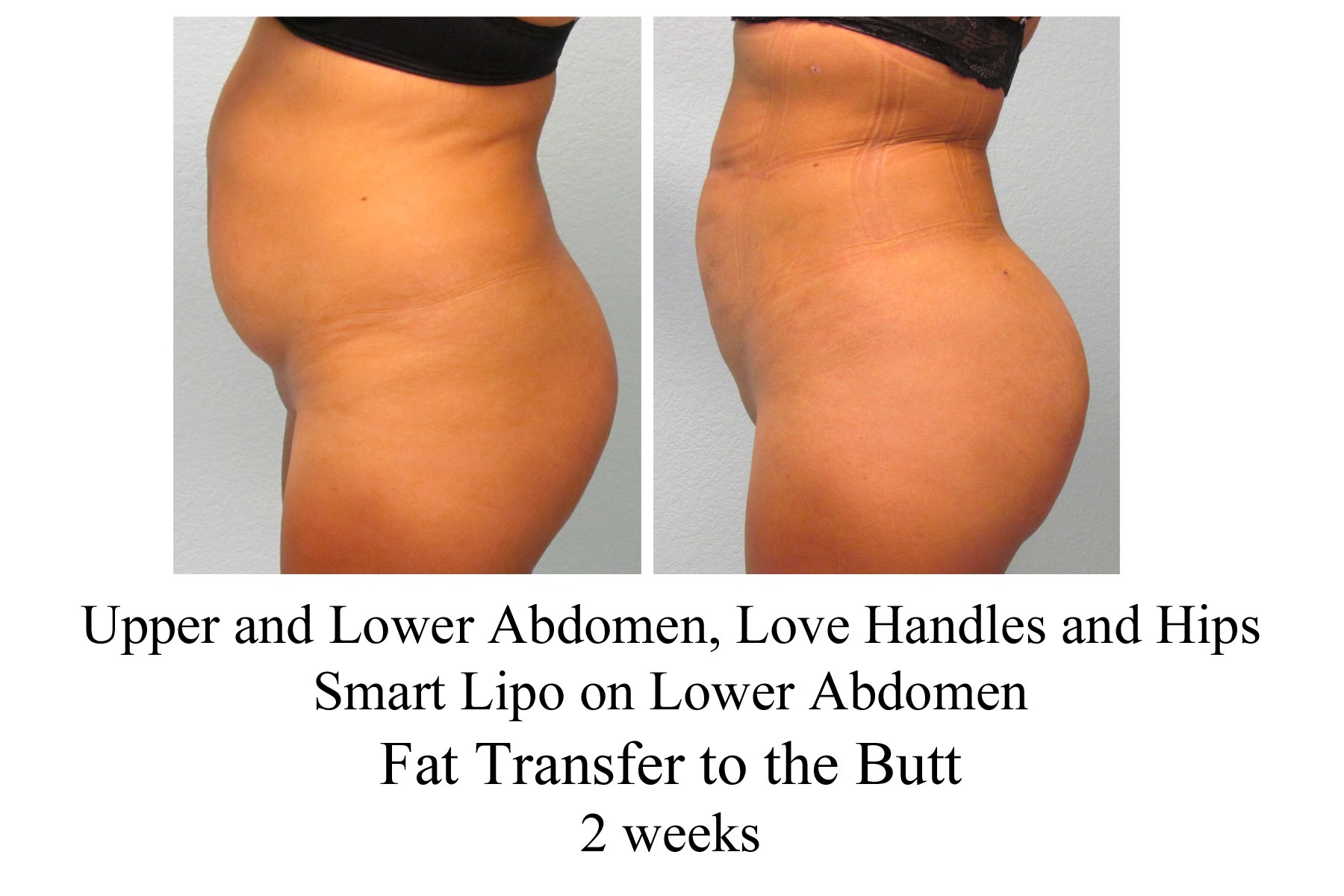 Fat Transfer To The Butt 30