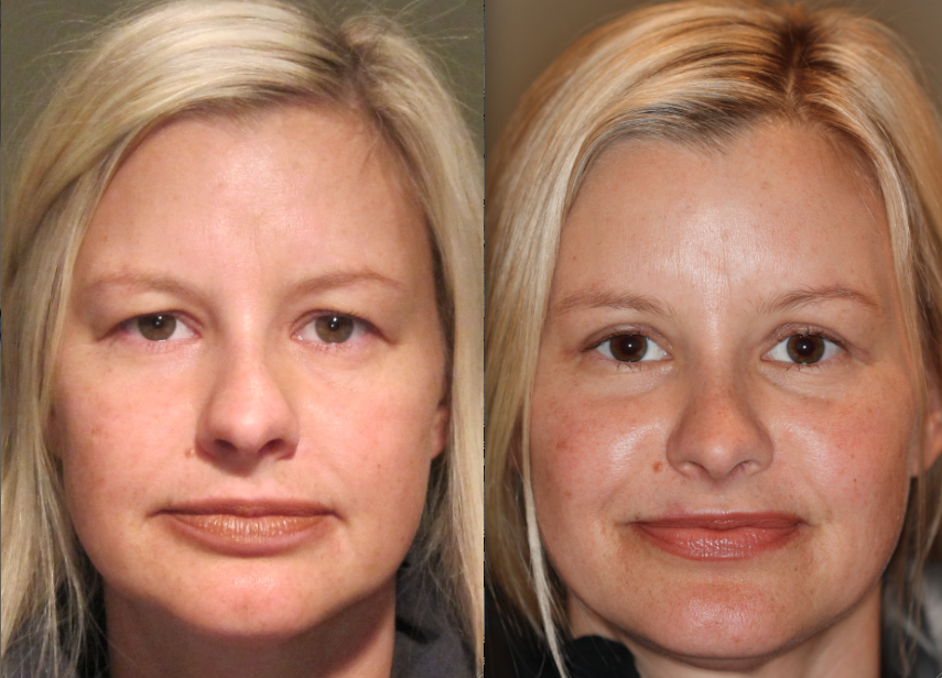 blepharoplasty before and after young