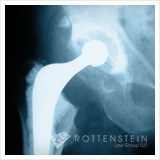 DePuy ASR Hip Replacement