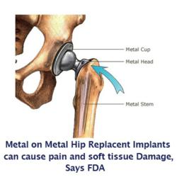 If you or someone you love have been injured by a DePuy ASR, DePuy Pinnacle, or Stryker Hip metal on metal hip replacement implant, please visit yourlegalhelp.com, or call toll-FREE 1-800-399-0795