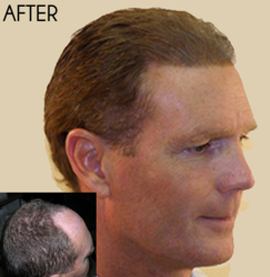 gI_60183_hair-restoration-Los-Angeles-hair-transplant.png