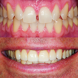 Obsidian Lithium Silicate Ceramic Before and After
