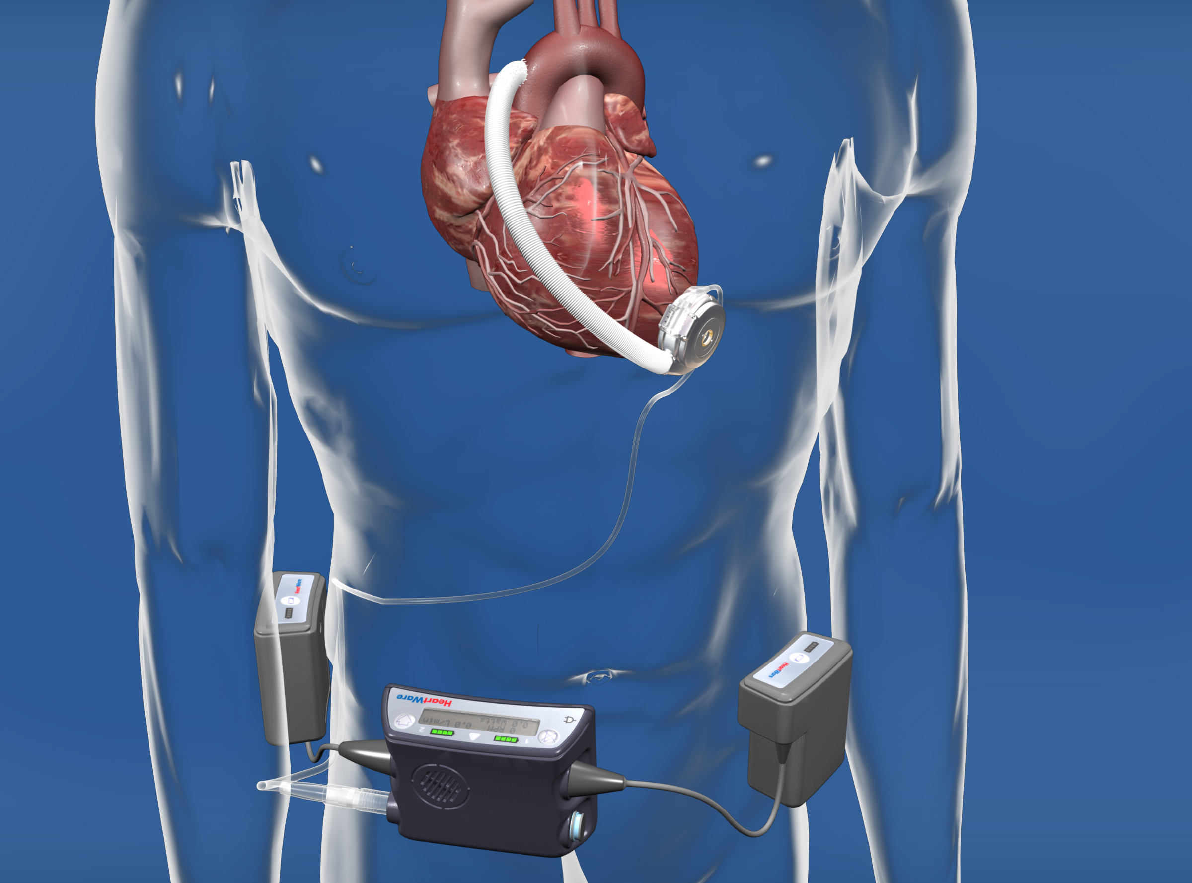 Ventricular Assist Device