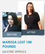 Marissa lost 100 Pounds with Gastric Bypass