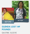 Glenda lost 149 Pounds with Gastric Sleeve