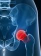 Metal Hip Replacement, Pain and Recovery Assistance Information Resource Expanded by McSweeney / Langevin