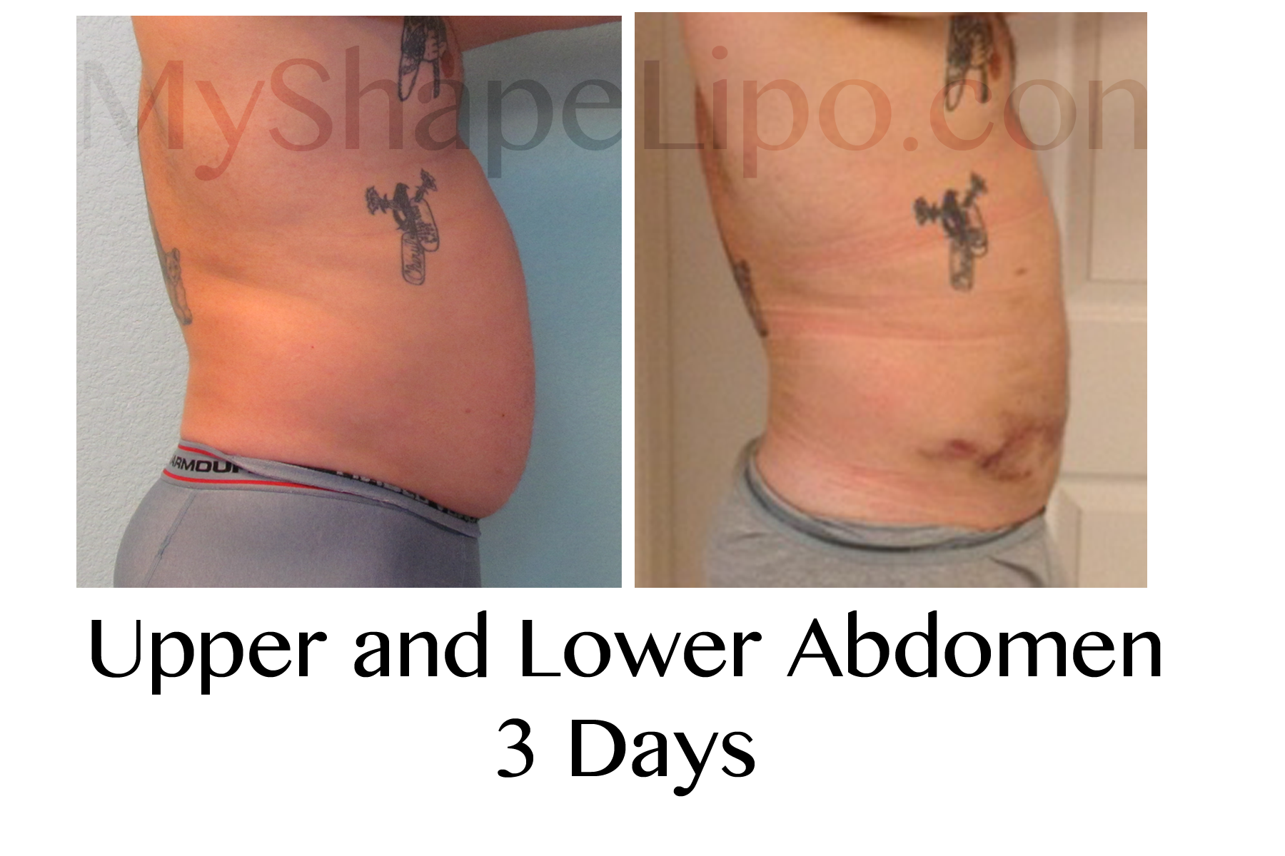 liposuction recovery time stomach