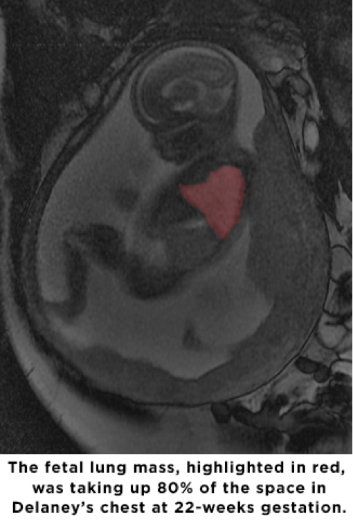 St. Louis Fetal Care Institute Develops Life Saving Before Birth