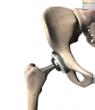 DrugRisk Adds Update on Stryker Hip Recall: Claims Could Cost $190 to 390 Million