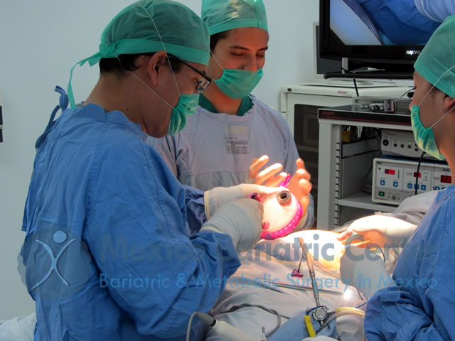 Mexico Bariatric Center Performs Single Incision Gastric