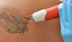New Laser Tattoo Removal Technology Fulfills Need for More Effective Tattoo  Removal