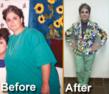 Successful Gastric Bypass Procedure Performed by Dr. Nilesh Patel...