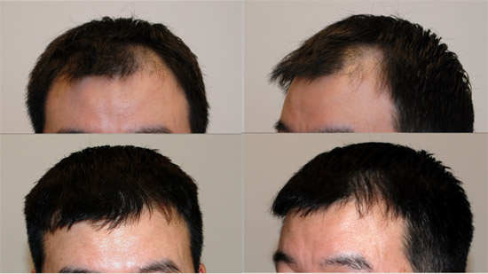 finasteride before and after temples