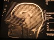 New Study Shows Damage Caused by Concussion May Linger: New York...