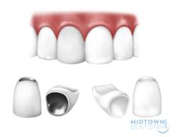 midtown dentistry provides zirconia crowns