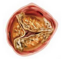 Stenotic Aortic Valve