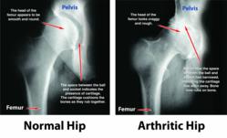 hip xray normal vs bad hip joints