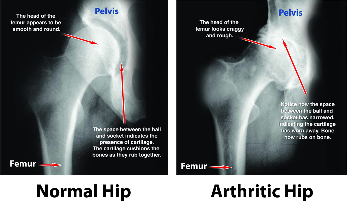 hip osteoarthritis xray vs normal hip