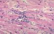 New Study Links Pradaxa to Increased Risk of Infection: Now,...