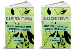 home remedies for acne review