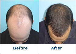 Provillus New Hair Loss Product Provides Hair Regrowth for Men and Women;  Now Available at 