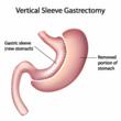 Sleeve Gastrectomy at Dallas Bariatric Surgery Practice Now Covered by...