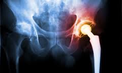 Results are in on 8-year Hip Replacement Study