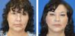 World-Renowned Facial Plastic Surgeon Performs Corrective Facelift...