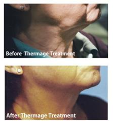 Before and After Neck Thermage
