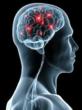 New Lawsuit on Pradaxa Brain Hemorrhage: Now, AttorneyOne Can Provide...