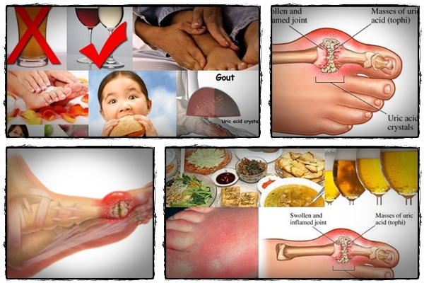 Gout Remedies  “Gout Remedy Report” Instructs People How to Cure 