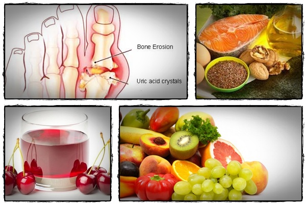 Gout Remedies  “Gout Remedy Report” Instructs People How to Cure 